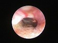 鼓膜外側面凹部がよくみえる(23.と同期に光源を180°回転)