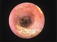 洗浄後にはっきりとした鼓膜を確認（鼓膜周辺部の毛は少ない）