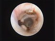 脆弱な鼓膜（?）が確認される