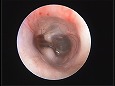清潔になった鼓膜（耳道は刺激で少し腫れた）