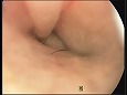 耳道に存在する黄色の分泌物