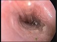 把持鉗子で毛と分泌物を摘出中，レンズに汚れが付着し曇る