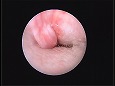 腫れがひいた耳介