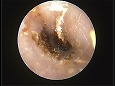 脆弱な鼓膜（?）が確認される