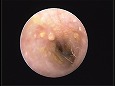 脆弱な鼓膜（?）が確認される