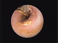 清潔になった鼓膜（耳道は刺激で少し腫れた）