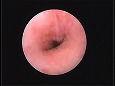 清潔になった鼓膜（耳道は刺激で少し腫れた）