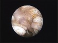 清潔になった鼓膜（耳道は刺激で少し腫れた）