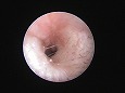 清潔になった鼓膜（耳道は刺激で少し腫れた）