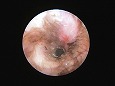洗浄後にはっきりとした鼓膜を確認（鼓膜周辺部の毛は少ない）