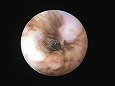 鼓膜に突き刺さるように落下した毛