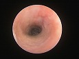脆弱な鼓膜（?）が確認される
