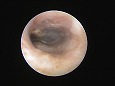 洗浄後にはっきりとした鼓膜を確認（鼓膜周辺部の毛は少ない）