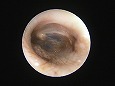 洗浄後，刺激で耳道がやや発赤している