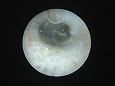 洗浄後，刺激で耳道がやや発赤している