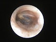 洗浄後，刺激で耳道がやや発赤している