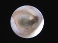 脆弱な鼓膜（?）が確認される