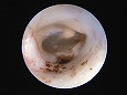 清潔になった鼓膜（耳道は刺激で少し腫れた）