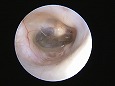 清潔になった鼓膜（耳道は刺激で少し腫れた）